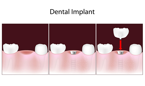 dental implants Manteno